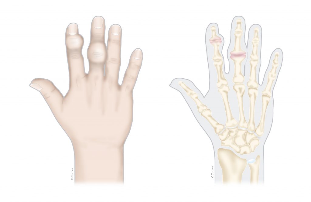 pregunta frecuentes artrosis de mano