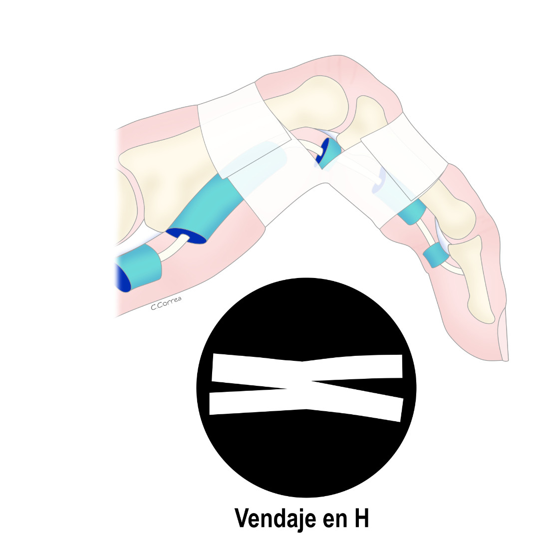 How climbers injure their fingers? Fabio TandioyClimbers injure fingers